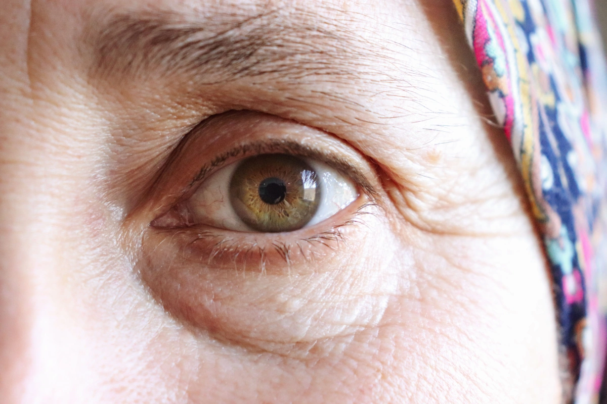 Fine Lines & Wrinkles